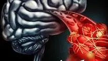 این اقدام را انجام دهید تا از سکته مغزی جان سالم به در ببرید
