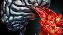 این اقدام را انجام دهید تا از سکته مغزی جان سالم به در ببرید
