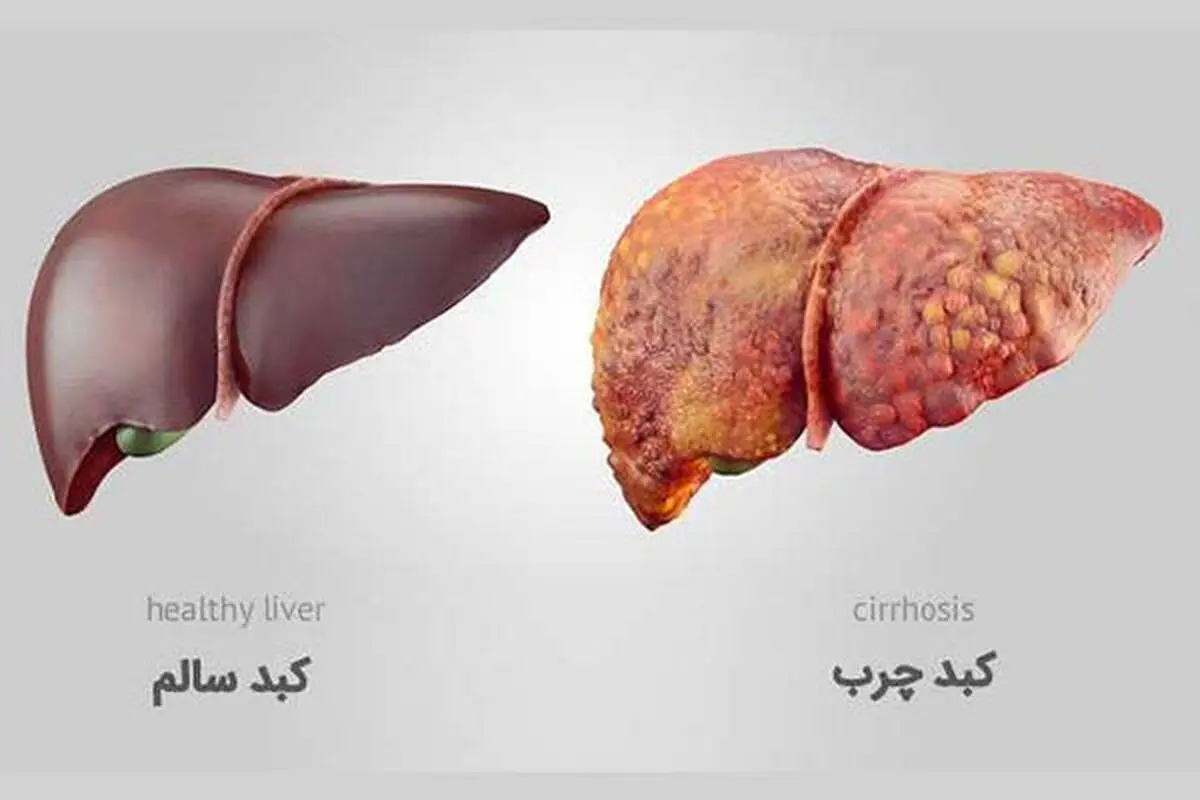 یکی از اصلی ترین دلایل مبتلا شدن افراد به کبد چرب
