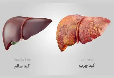 یکی از اصلی ترین دلایل مبتلا شدن افراد به کبد چرب
