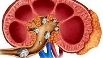 این کارها را انجام دهید تا سنگ کلیه نگیرید