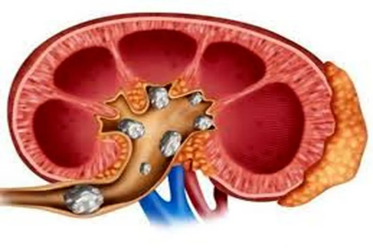 این کارها را انجام دهید تا سنگ کلیه نگیرید