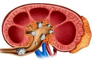 این کارها را انجام دهید تا سنگ کلیه نگیرید