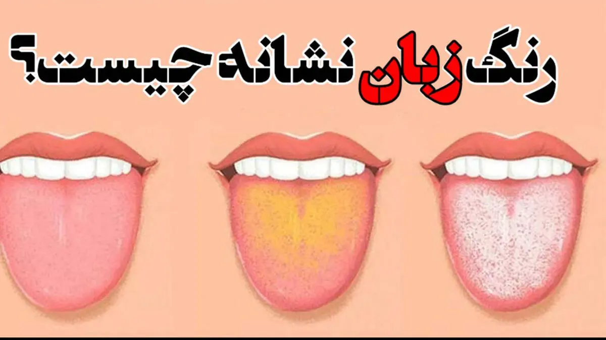 رنگ زبان نشان دهنده چه بیماری هایی است؟