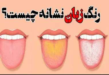 رنگ زبان نشان دهنده چه بیماری هایی است؟