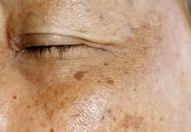 چگونه از لکه‌های تیره پوست خلاص شویم؟