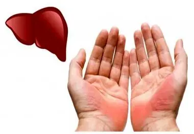 این تغییرات در کف دست ها نشانه بیماری کبدی است