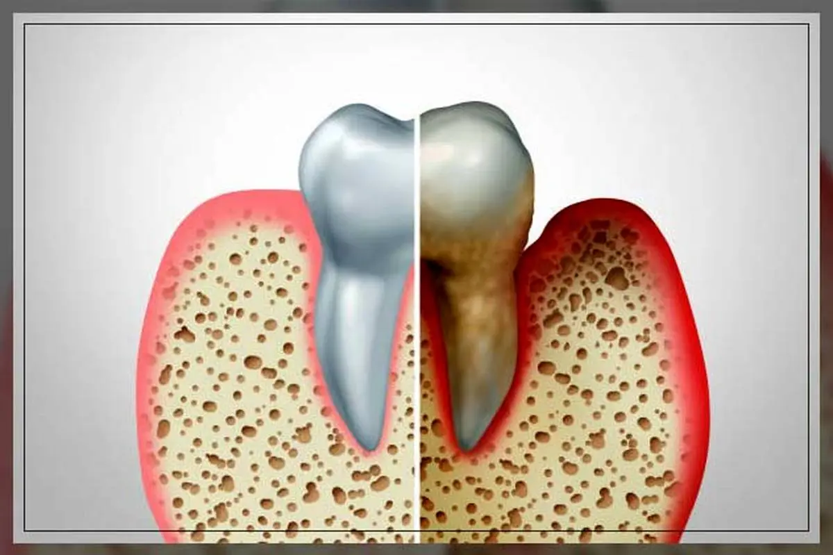 این نشانه در دندان یعنی پوکی استخوان دارید
