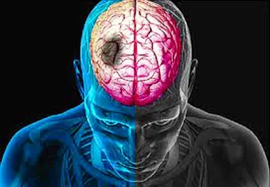 این زنگ خطرهای جدی درباره سکته مغزی را جدی نگیرید ضرر می‌کنید