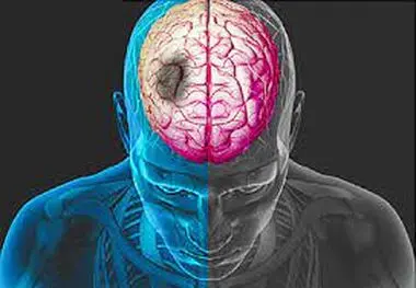 این زنگ خطرهای جدی درباره سکته مغزی را جدی نگیرید ضرر می‌کنید