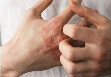 چرا پوست بعضی‌ها به فلزات حساسیت دارد؟