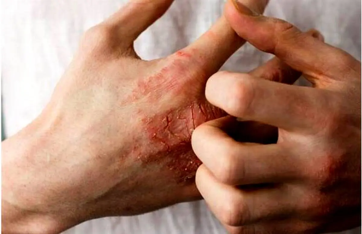 چرا پوست بعضی‌ها به فلزات حساسیت دارد؟