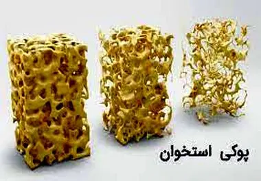 «کلسیم نانویی ایرانی» به درمان پوکی استخوان کمک می‌کند