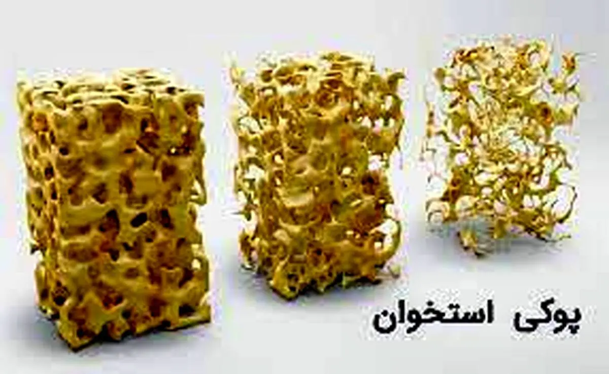«کلسیم نانویی ایرانی» به درمان پوکی استخوان کمک می‌کند
