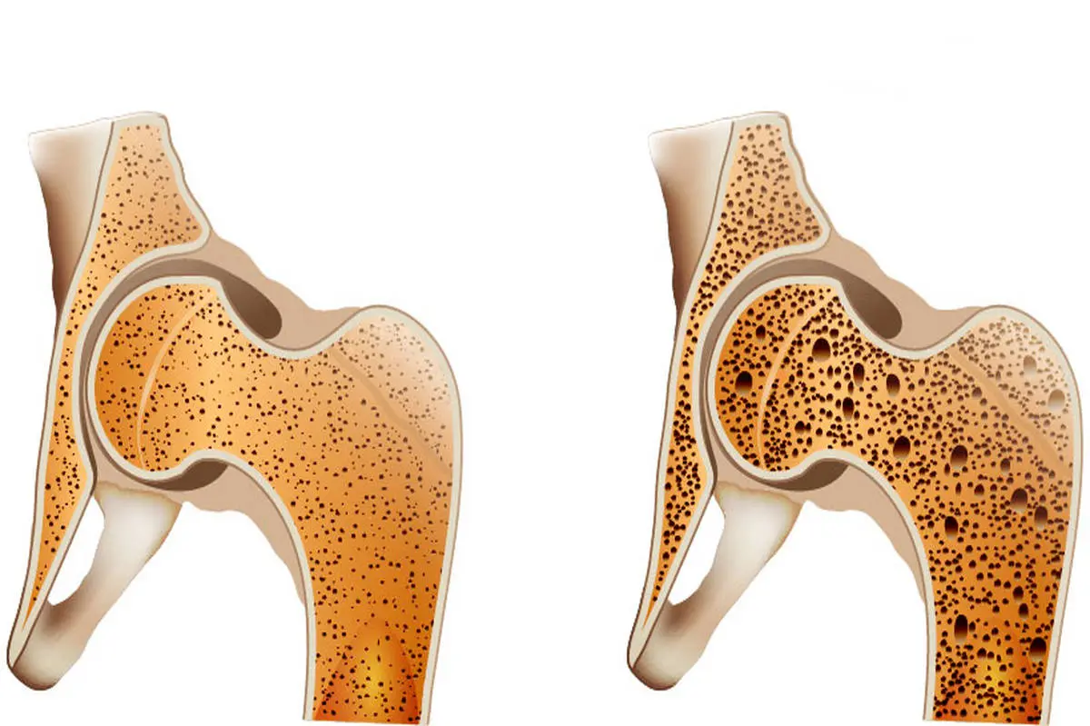 اگر پوکی استخوان دارید، بخوانید