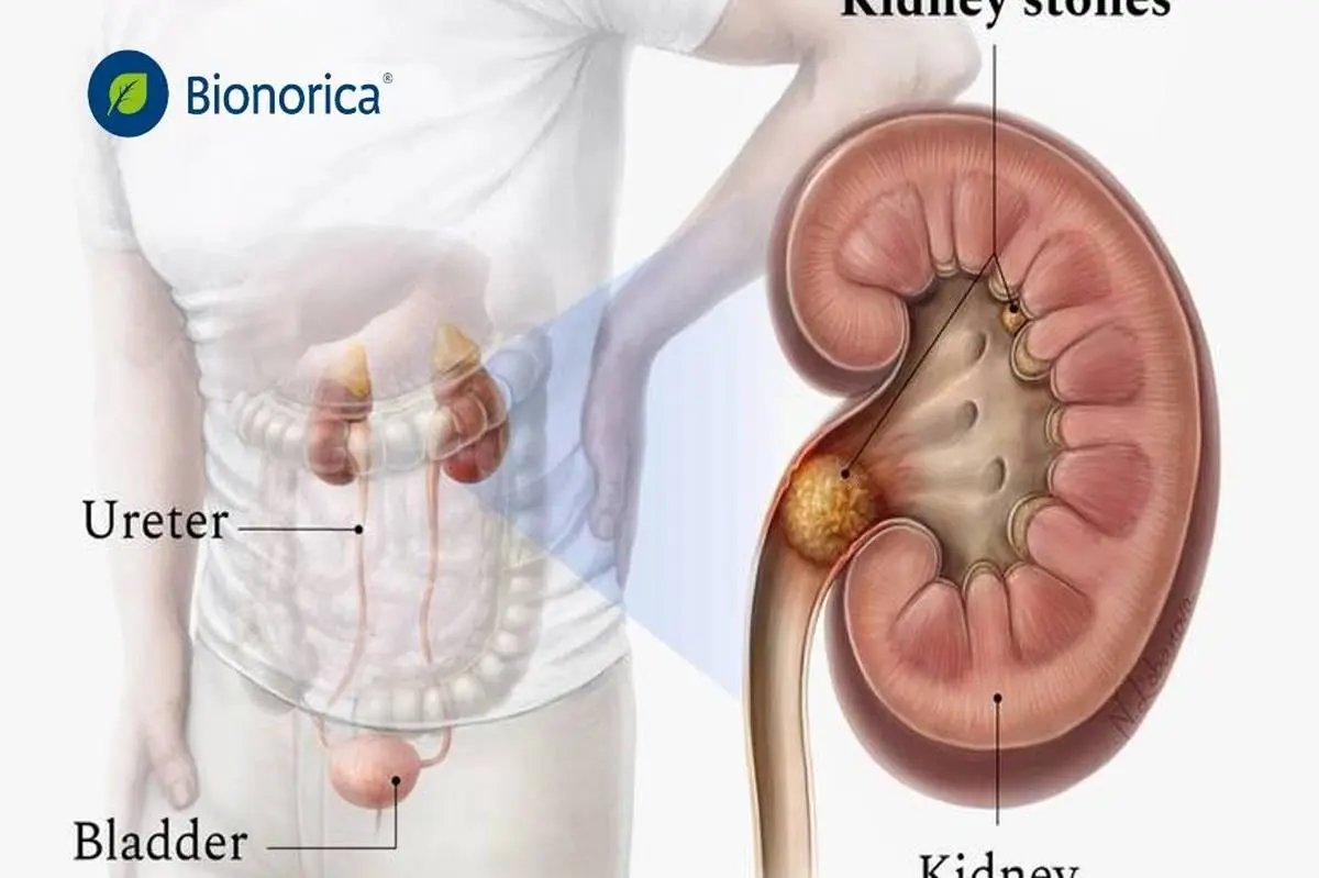 چگونه از سنگ کلیه در امان بمانیم؟
