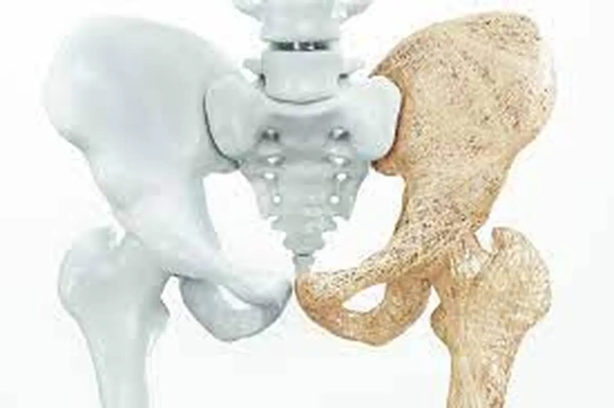 نقش آلودگی هوا در افزایش ریسک ابتلا به پوکی استخوان