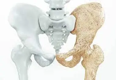 نقش آلودگی هوا در افزایش ریسک ابتلا به پوکی استخوان