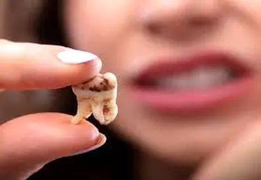 با مصرف این خوراکی ها از پوسیدگی دندان در امان می مانید