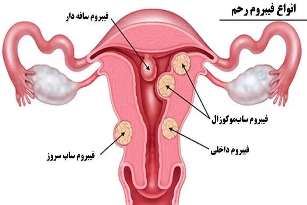 علت ایجاد فیبروم