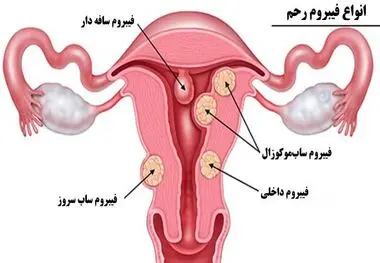 علت ایجاد فیبروم