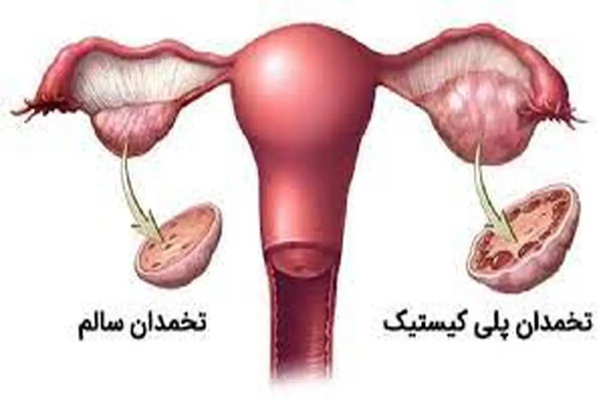 اگر سندرم تخمدان پلی کیستیک دارید از این رژیم غافل نشوید