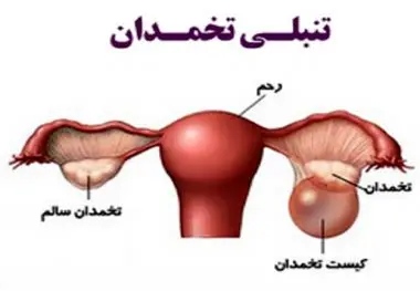 تنبلی تخمدان در این شرایط باعث مرگ می شود ، تنبلی تخمدان را با این مواد غذایی درمان کنید