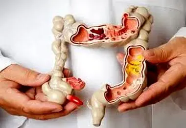 این ۵ ماده غذایی دشمن یبوست هستند