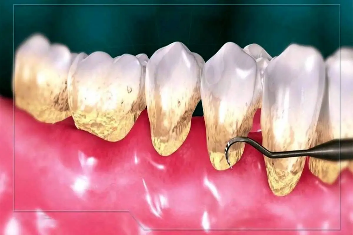 چرا باید جرم گیری دندان را جدی بگیریم؟