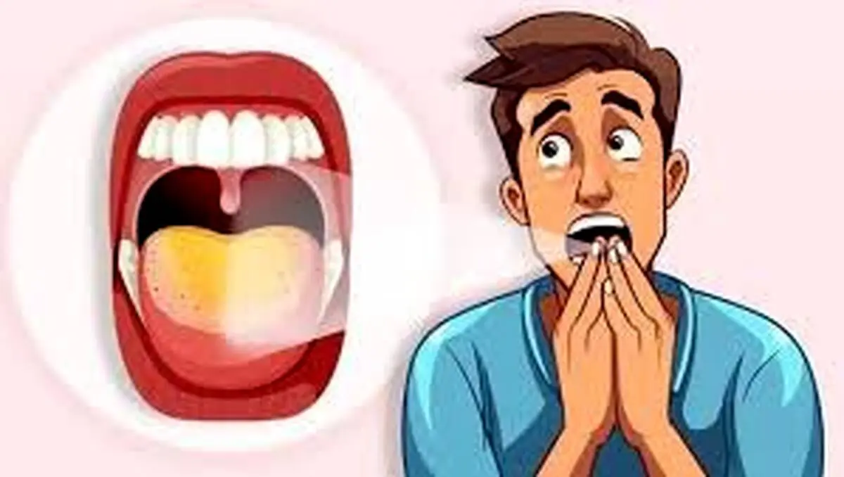 دلایل زردی زبان چیست؟