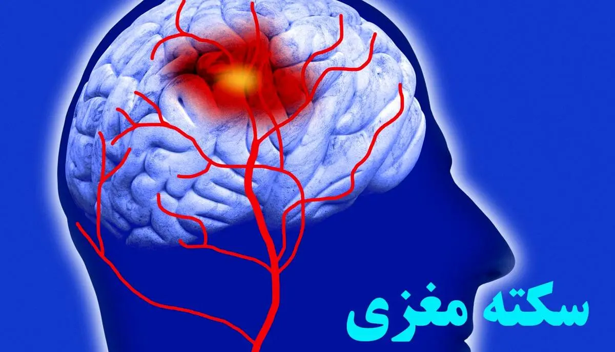 علائمی ساده که باورتان نمی شود خبر از سکته مغزی می دهند!